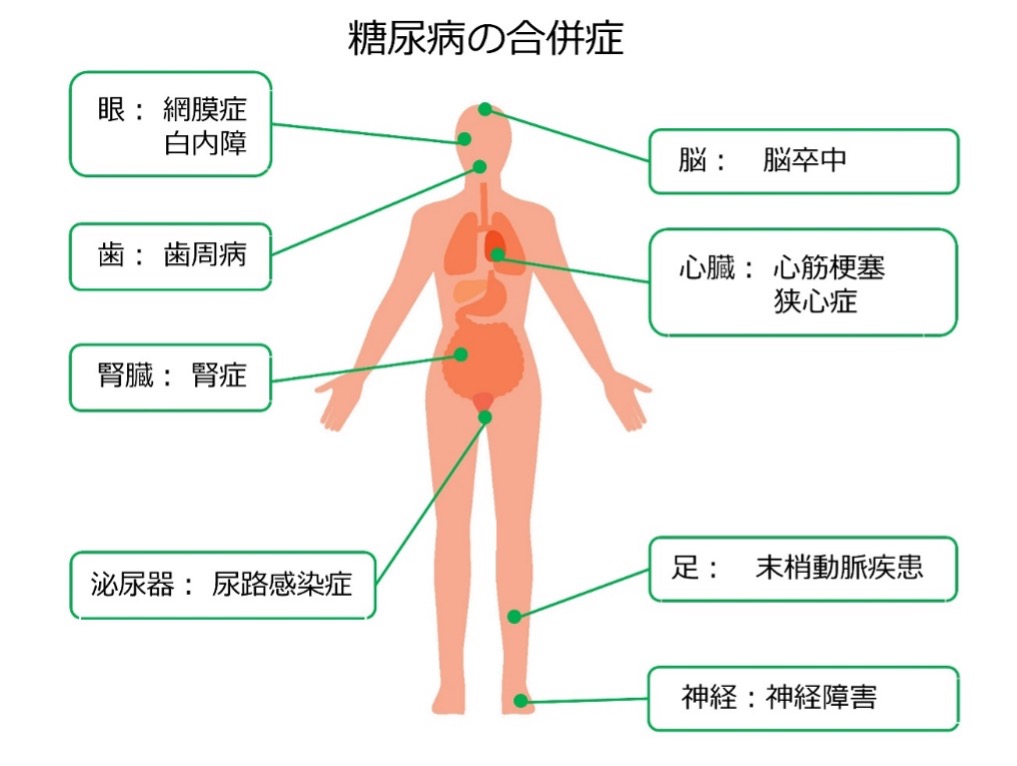 ④糖尿病の合併症