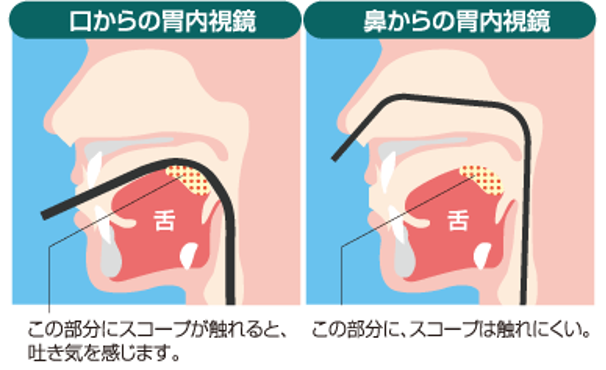 胃カメラ