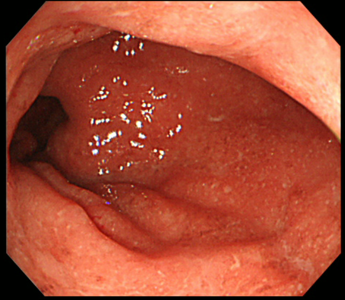 潰瘍性大腸炎