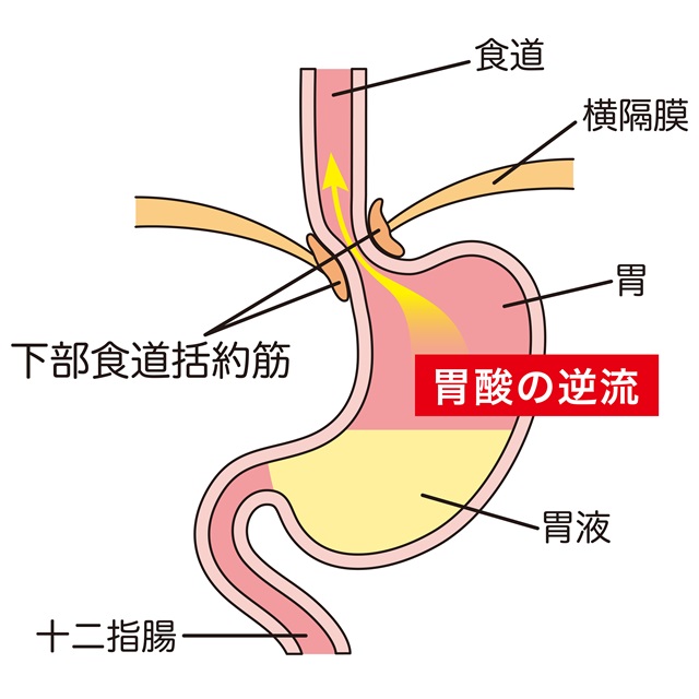 逆流性食道炎のメカニズム